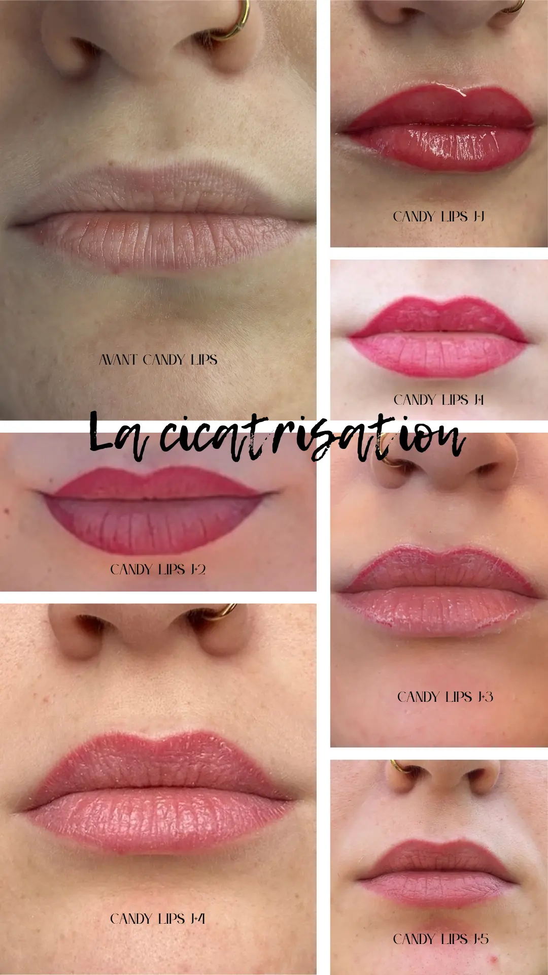 candy lips c'est quoi : Le candy lips est un procd de micro pigmentation qui se situe au niveau des lvres. ... Son application permet d'obtenir un effet dgrad sur les lvres CANDY LIPS & FULL